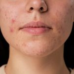 acne scars