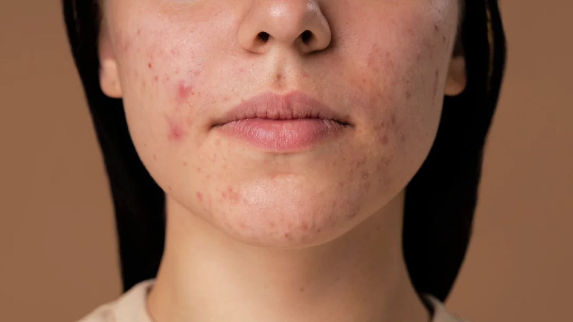 acne scars